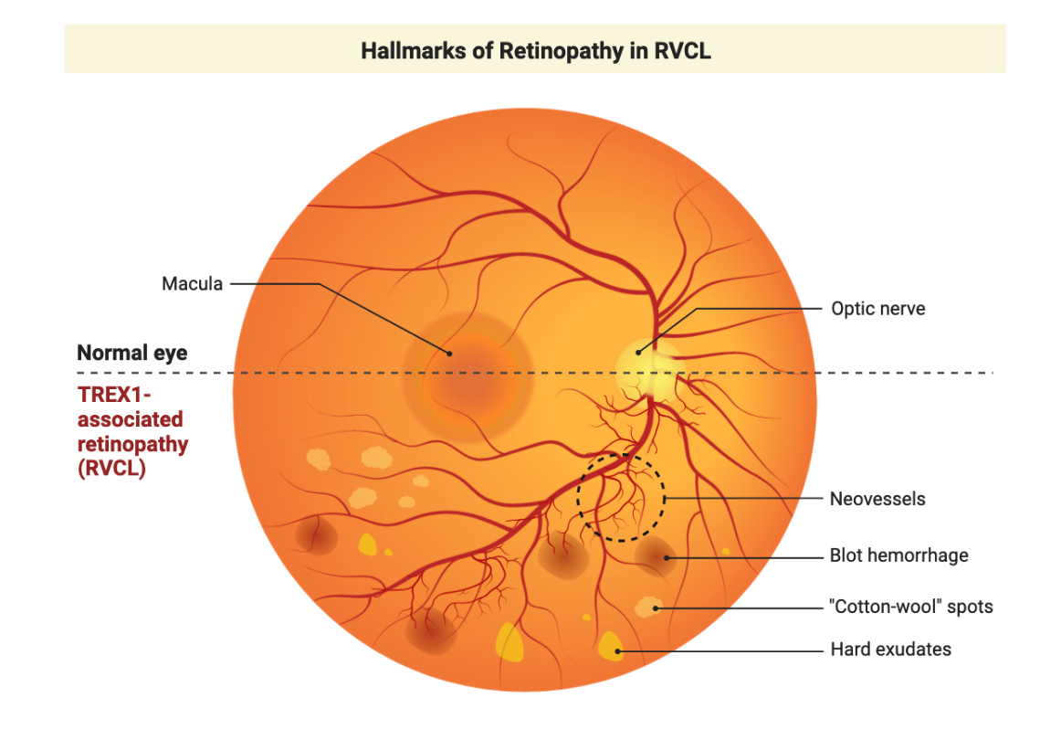 animation of retinopathy